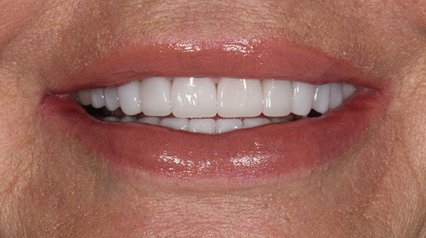 Pauly Dental | Crowns  amp  Caps, Veneers and Full Mouth Rejuvenation