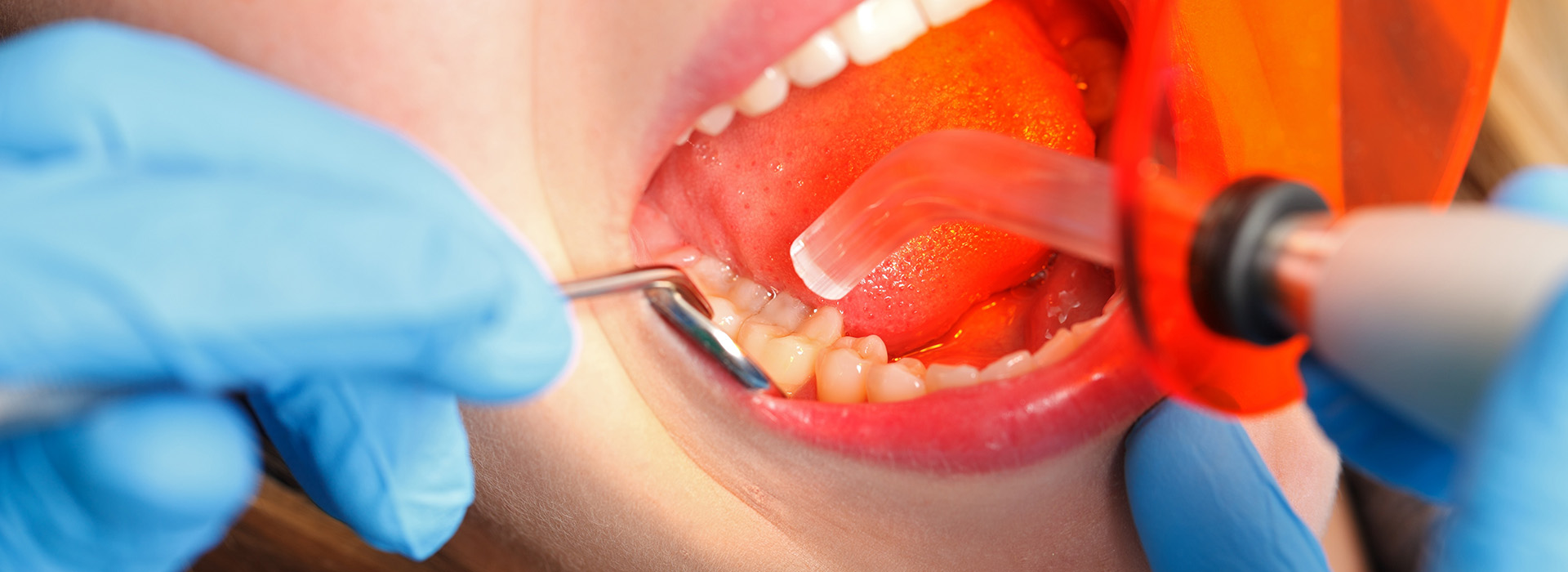 Pauly Dental | Emergency Treatment, Crowns  amp  Caps and Dental Cleanings